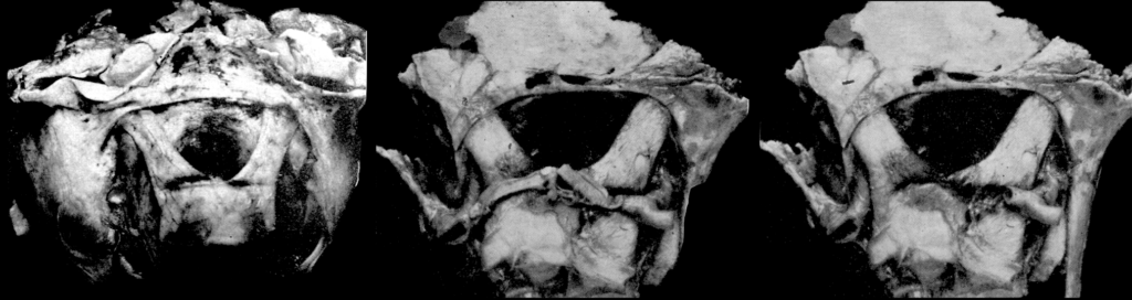 Kernohan’s Notch (Optic) 1953
