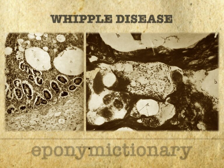 Whipple disease 1907 680