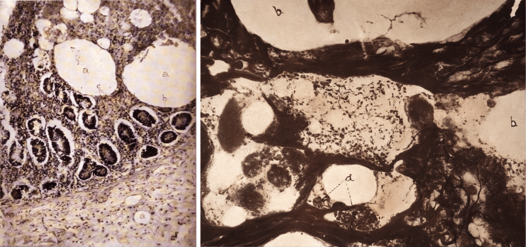 Whipple disease 1907 Fig 3 and Fig 9