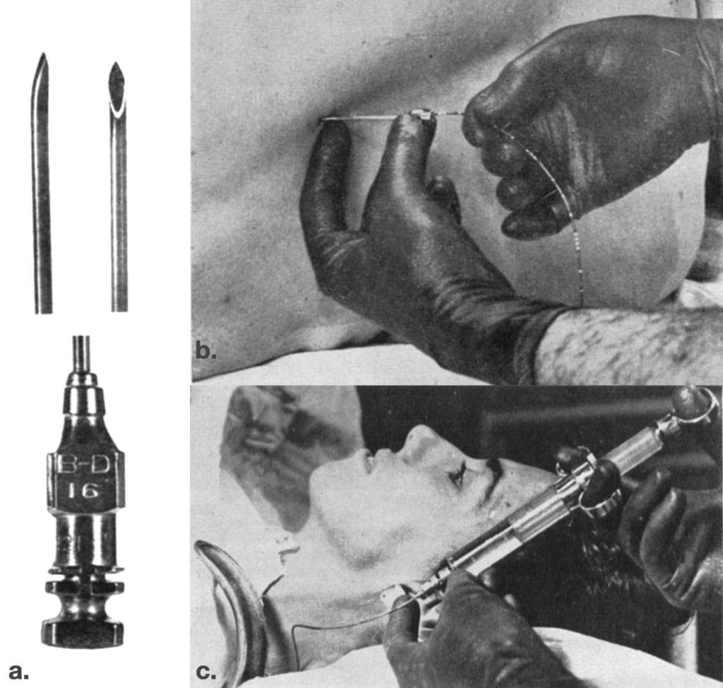 Continuous lumbar epidural catheter technique Curbelo 1949