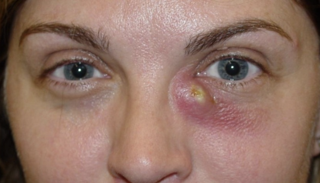 Dacryocystitis left eye adult