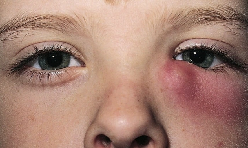 Dacryocystitis left eye child