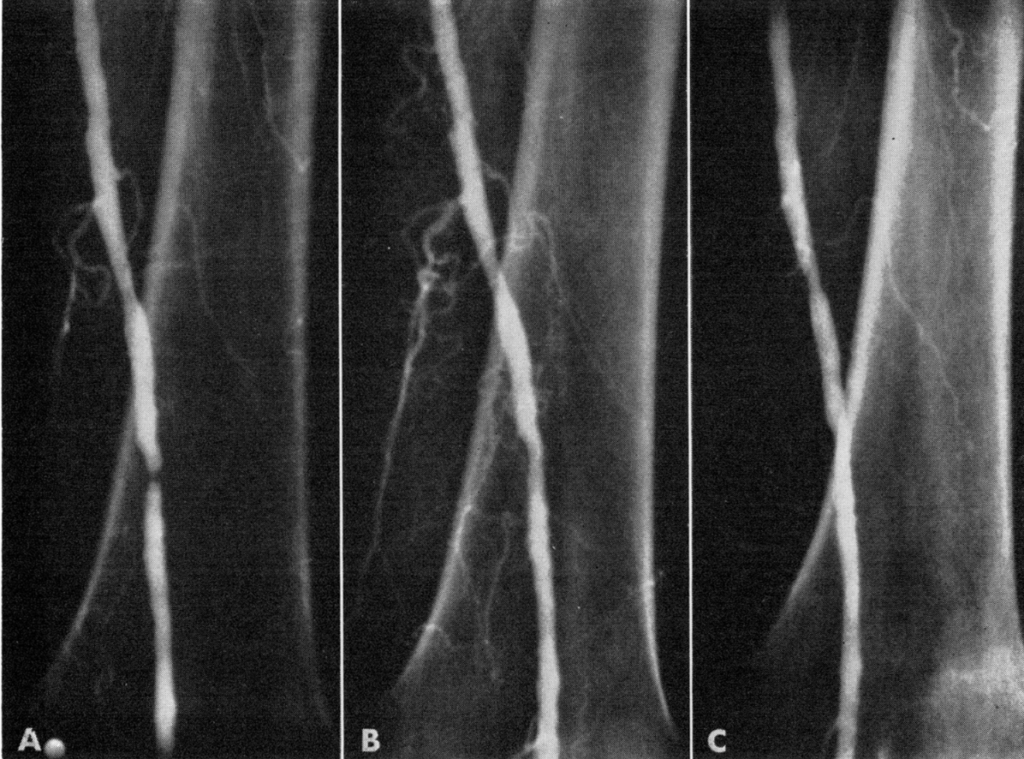 Dotter 1964 Transluminal dilatation