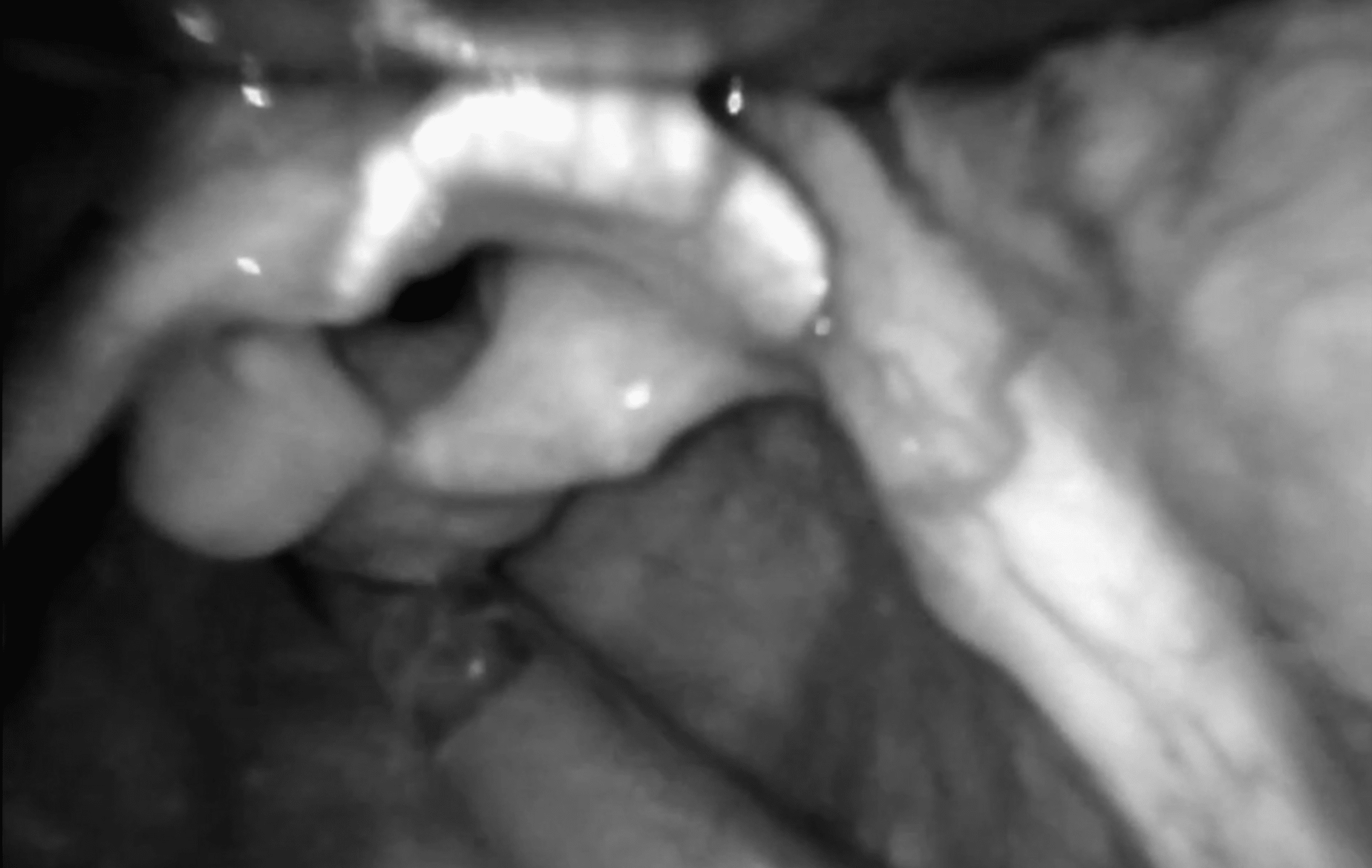 airway