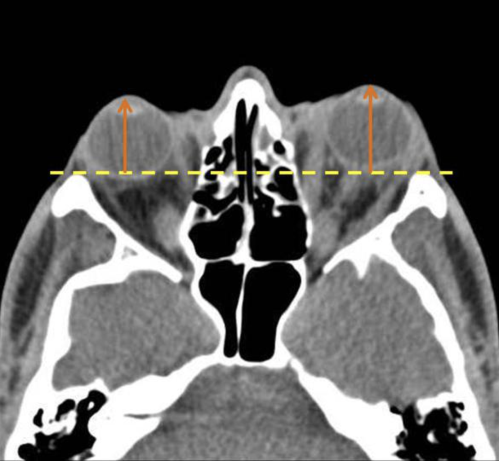 thyroid ophthalmopathy