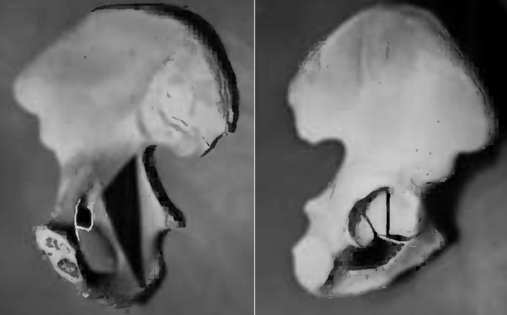 Anatomical basis of the Köhler teardrop, 1977