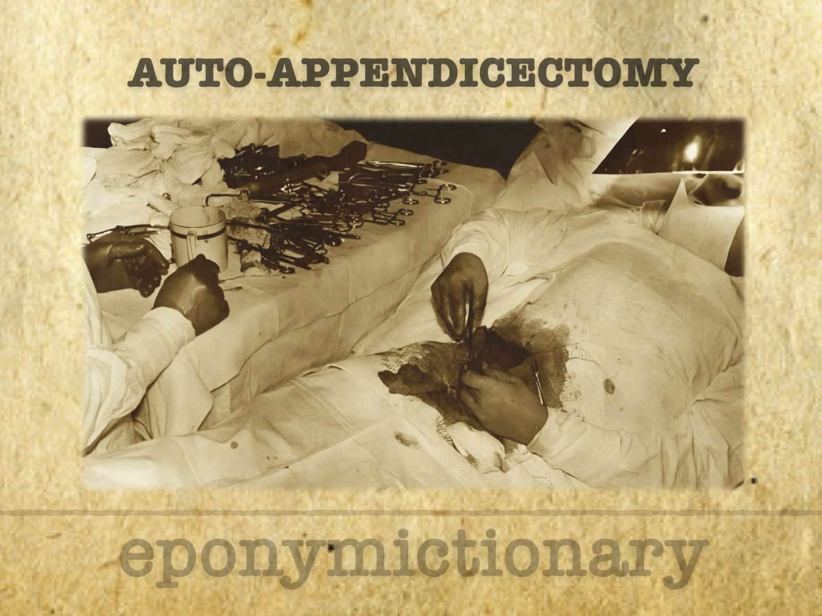 Auto-appendicectomy 680