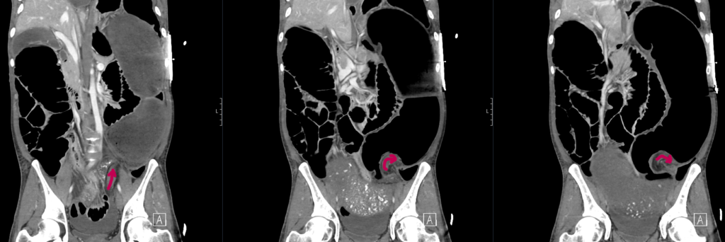 CT Case 102 Sigmoid volvulus