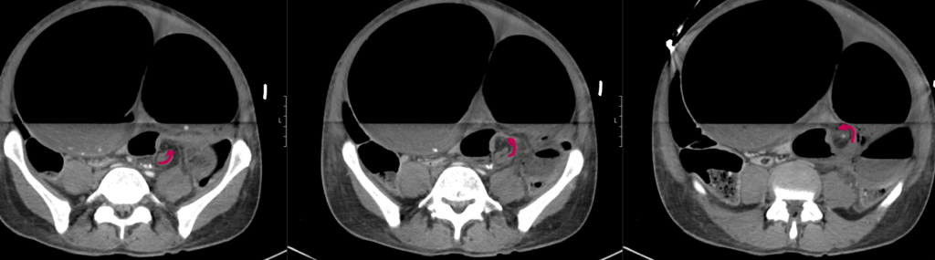 CT Case 102b Sigmoid volvulus