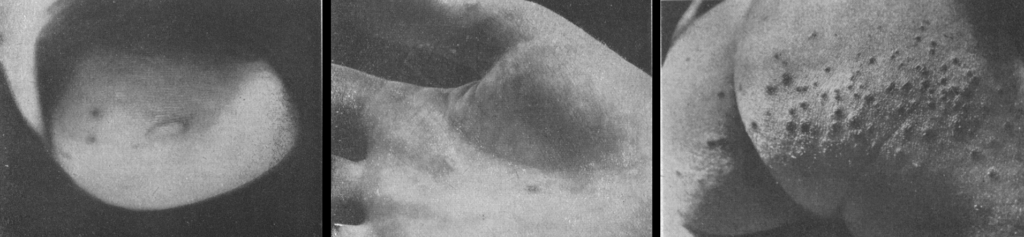 Alsop Hand-foot-and-mouth disease 1959