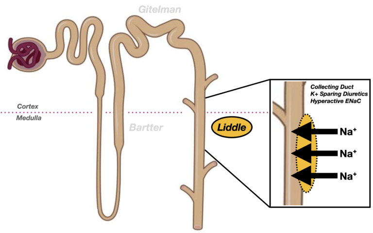 Liddle Syndrome • LITFL • Medical Eponym Library