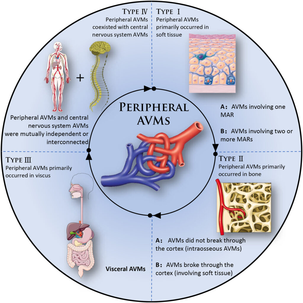 Peripheral Arteriovenous Malformations (AVMs)