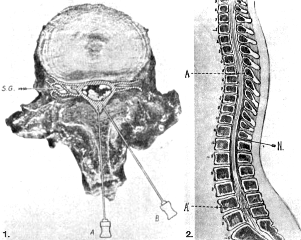 Segmental epidural spread 1933