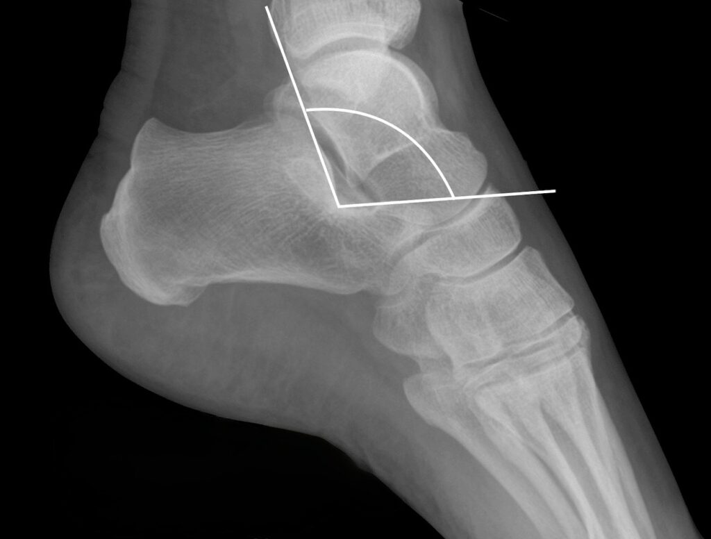 Critical-angle-of-Gissane