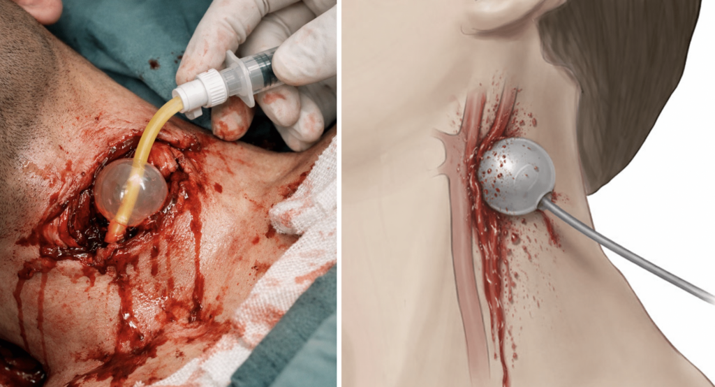 Foley balloon tamponade in major haemorrhage 2