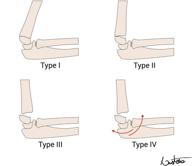 Gartland classification of supracondylar humeral fractures