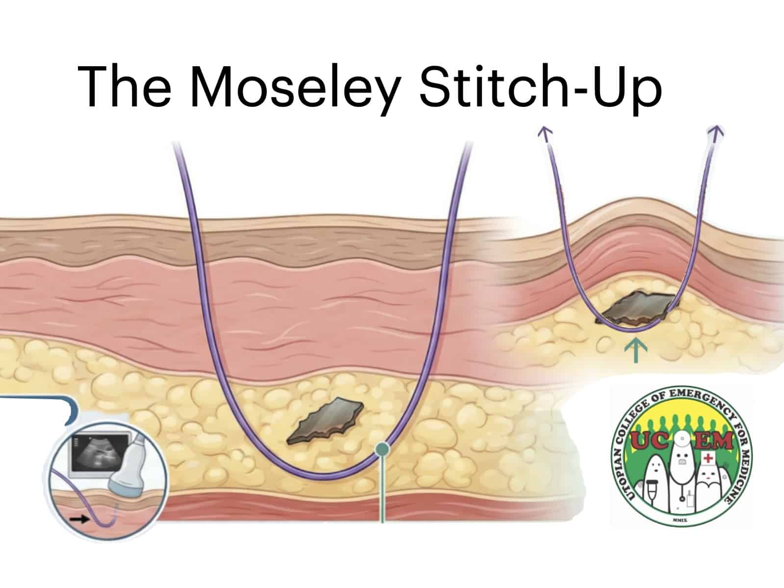 Moseley Stitch-Up UCEM 680