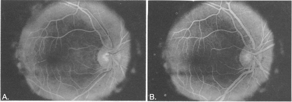 Novotny Alvis Photographing Fluorescence in Circulating Blood in the Human Retina 1961