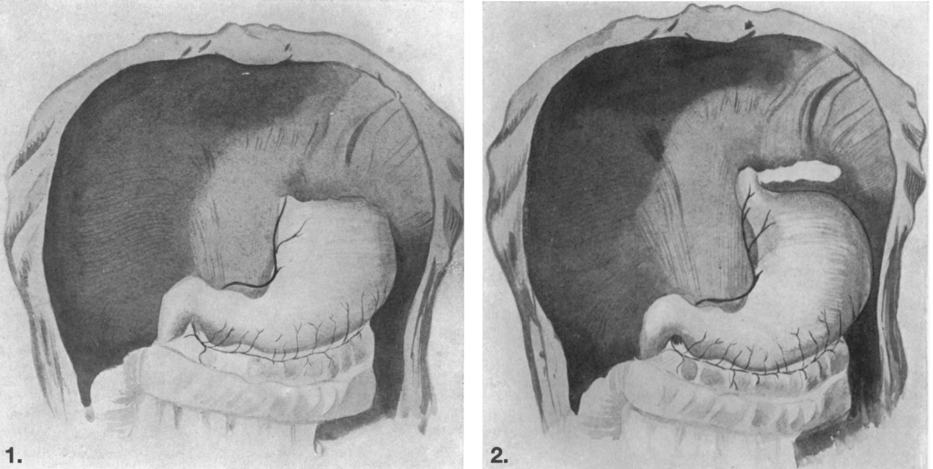 Soresi diaphragmatic hernia repair
