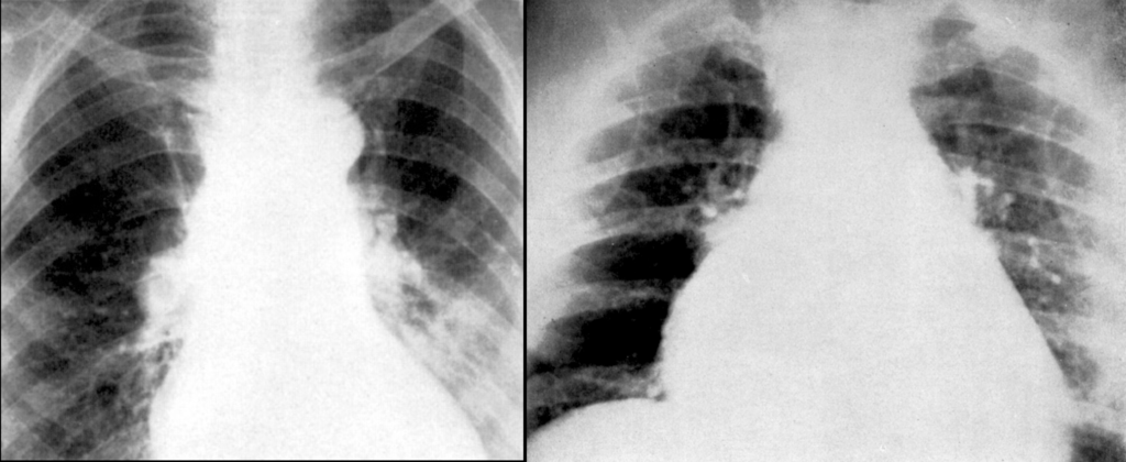 Westermark Case 2, Case 3 1938