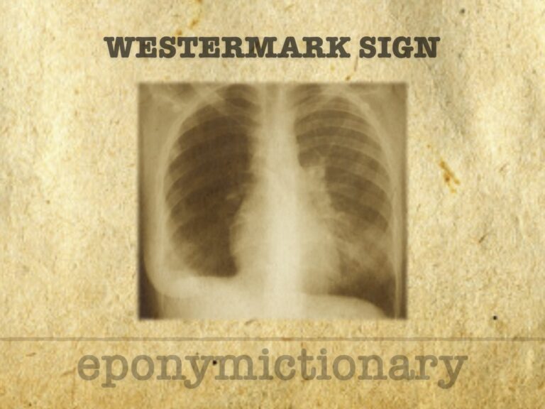 Westermark sign 680