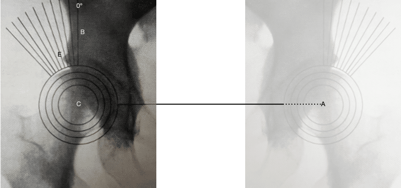 Wiberg’s centre-edge angle 1939 2