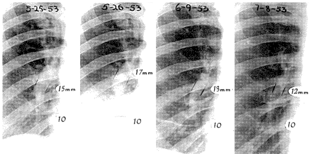 right pa Roentgen diagnosis of pulmonary embolism