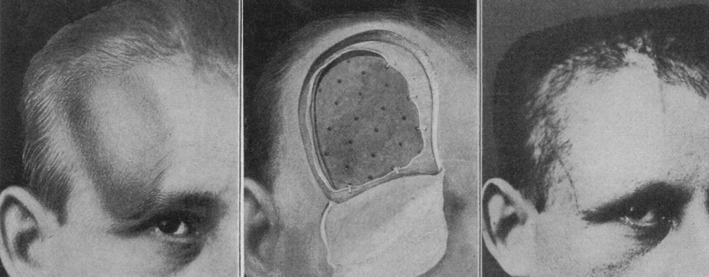 Babcock Soup Bone cranioplasty