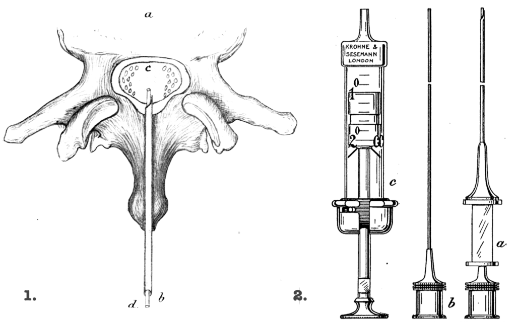 Barker 1907 spinal anaesthesia 1907 fig 4 and 5