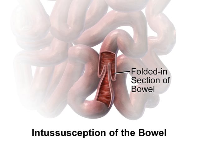 Intussusception diagram