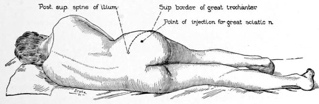 Labat approach to sciatic nerve block