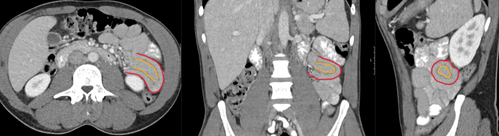CT Case 108 intussusception