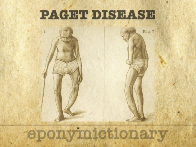 Paget disease of bone 680