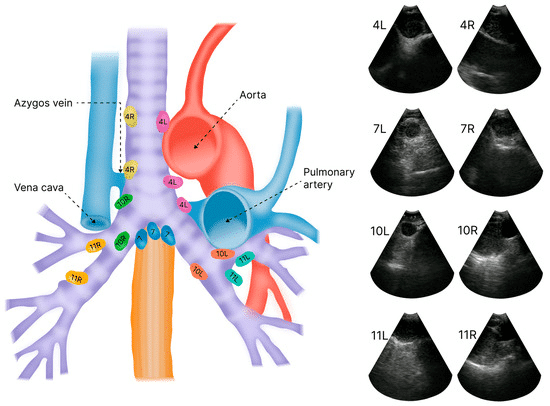 Regional mediastinal and hilar lymph node stations