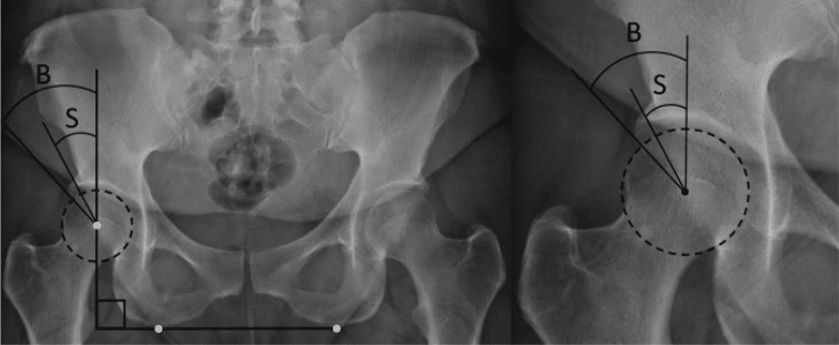 Bone edge versus sourcil endpoint, 2015