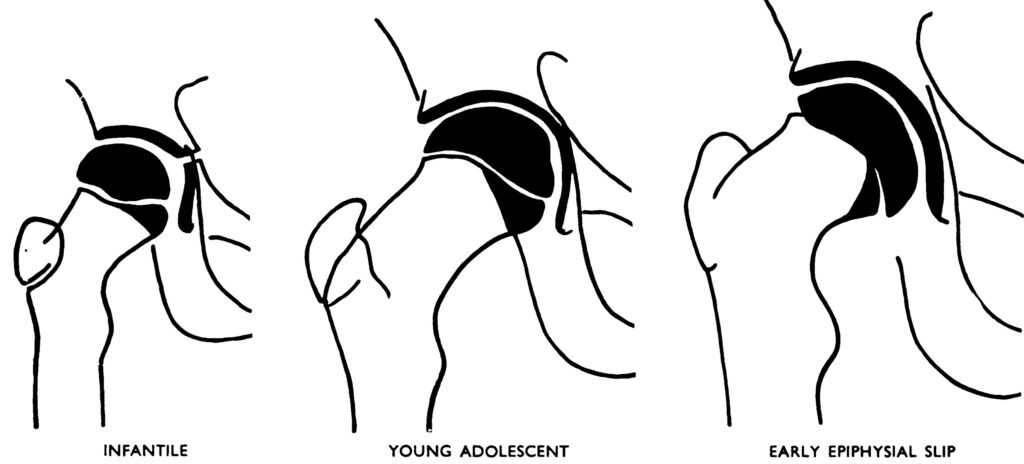 Early SCFE and loss of the diaphyseal contribution to the femoral head, Durbin 1960