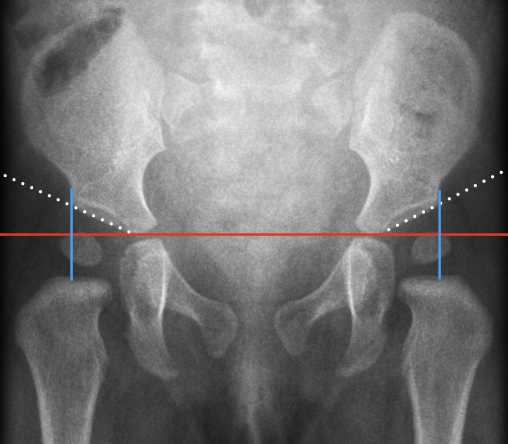 Hilgenreiner line and Perkin lines on an infant AP pelvis radiograph