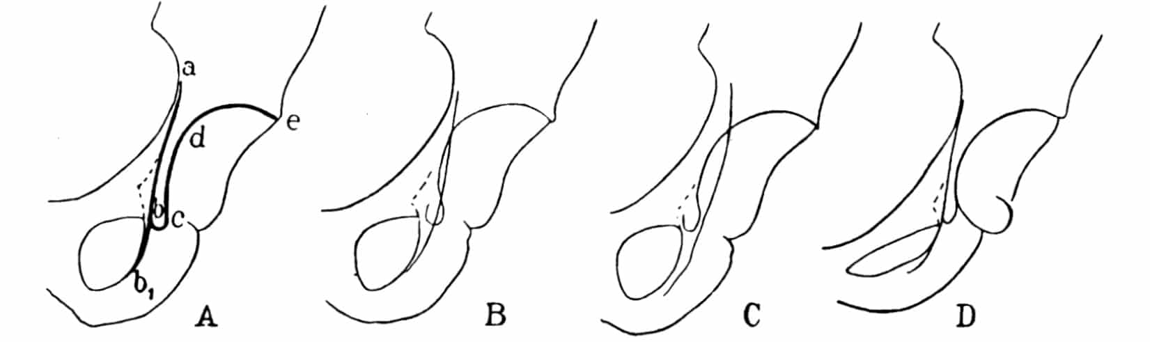 Köhler’s acetabular projection lines