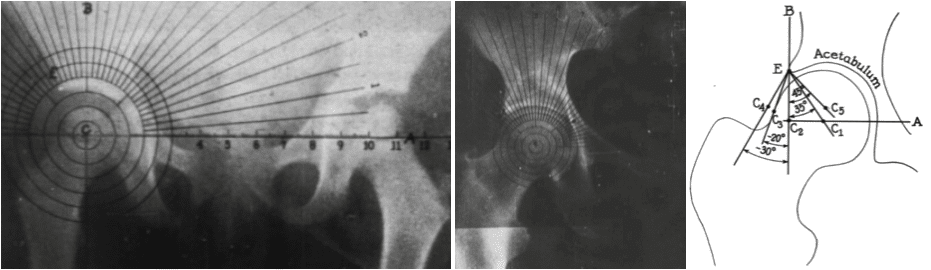 Massie–Howorth modification of the centre-edge angle, 1950