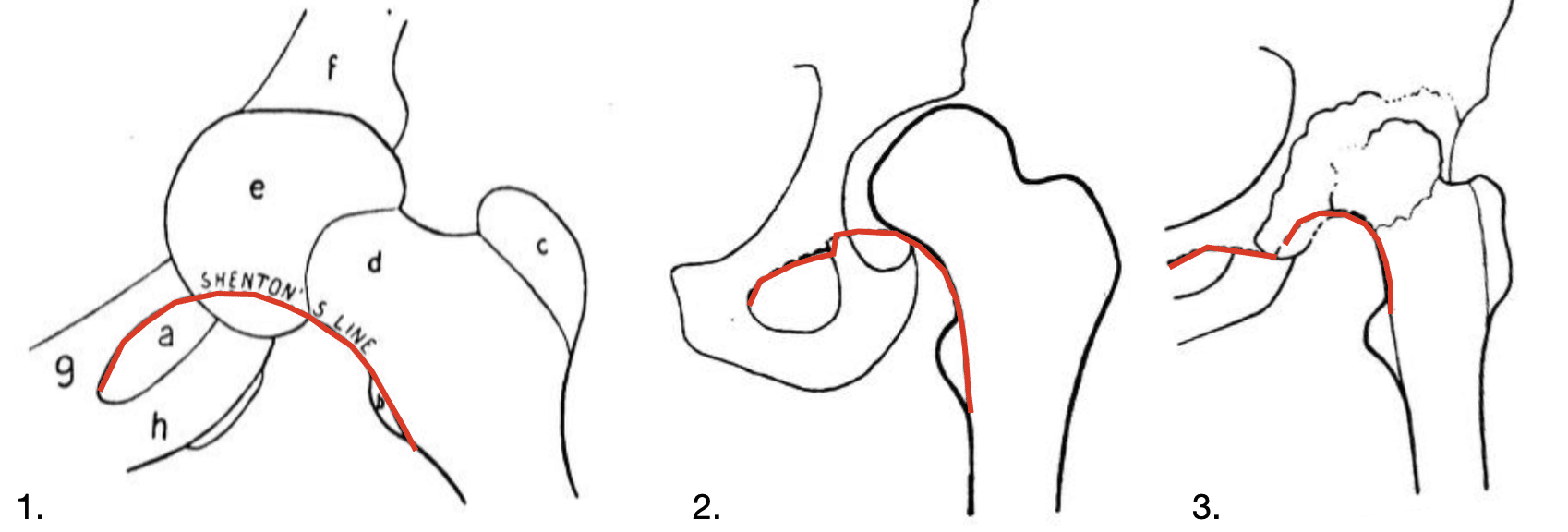 Renner's illustrations of Shenton's line, 1925