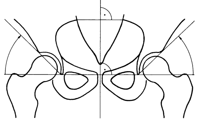 Sharp-Ullmann angle Tonnis 1987