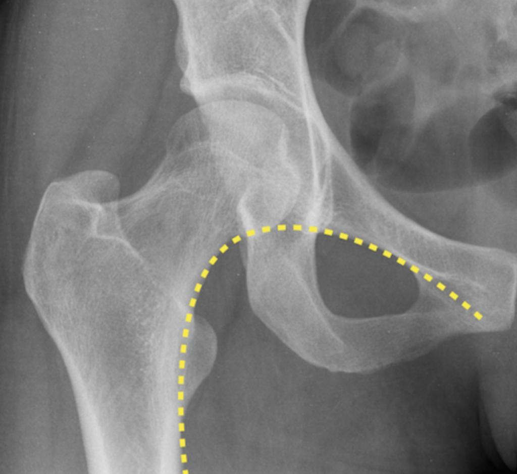 Shenton's line radiopaedia