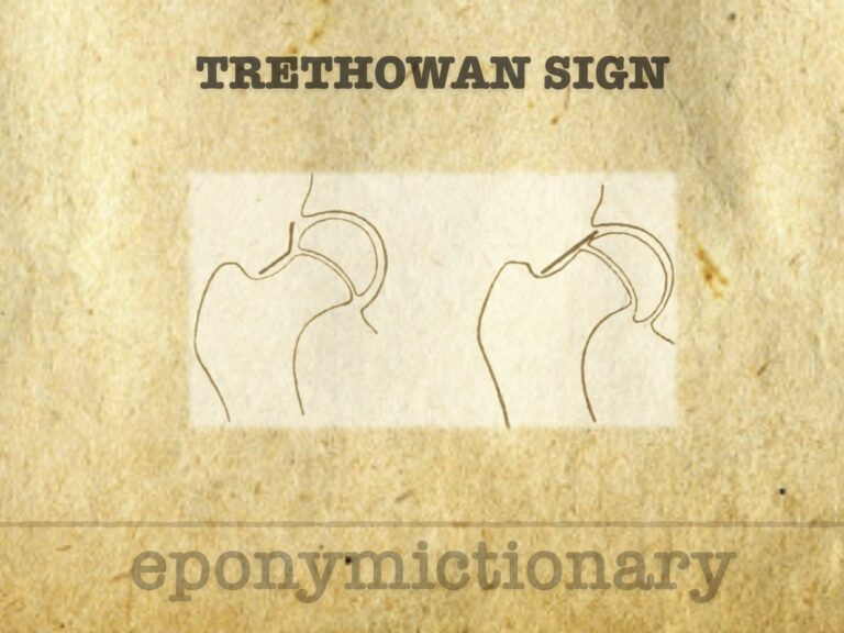 Trethowan sign 680