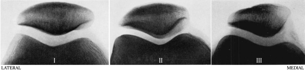 Wiberg patellar classification 1941