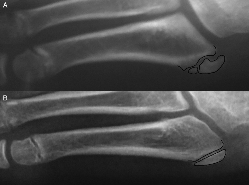 Apophysis in Iselin disease