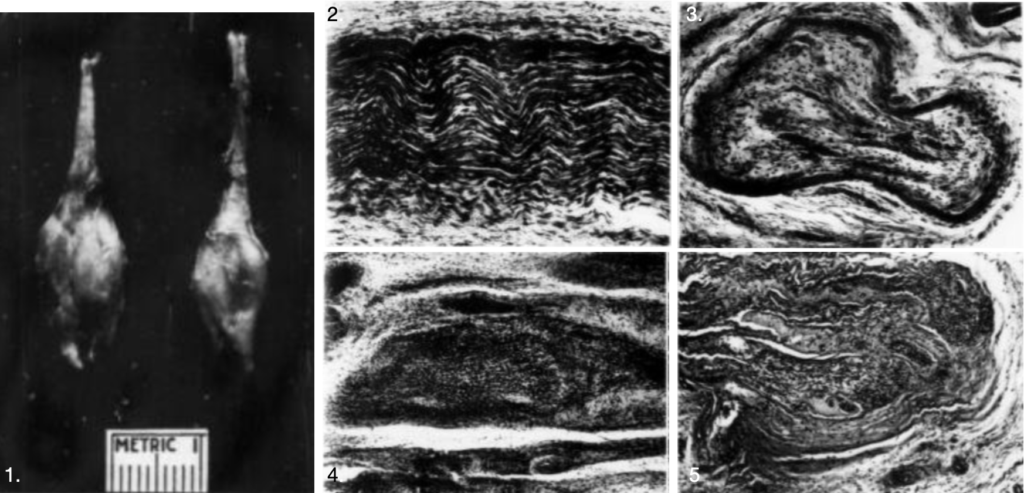 Bickel and Dockerty histology 1947