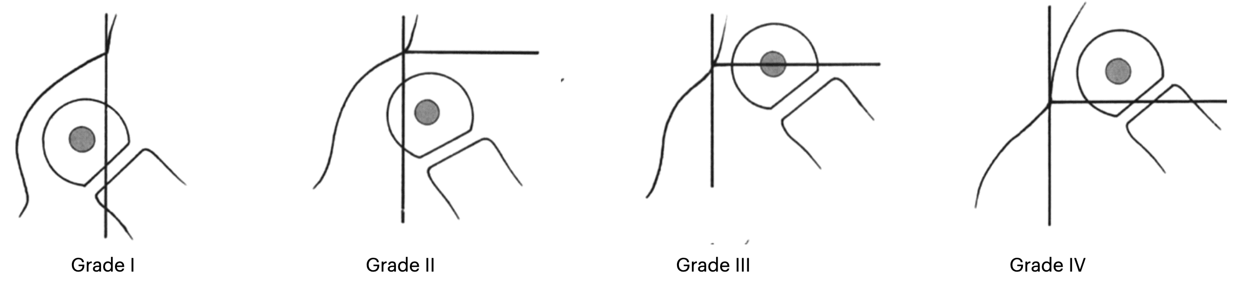 CSHD system for the grading of congenital hip dislocation 2