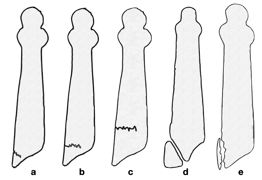 Differential diagnosis of Iselin disease