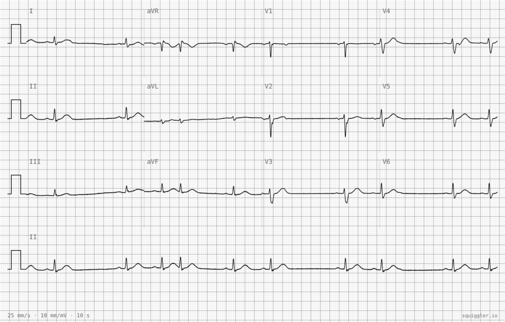 ECG Case 138 Three months of palpitations 01
