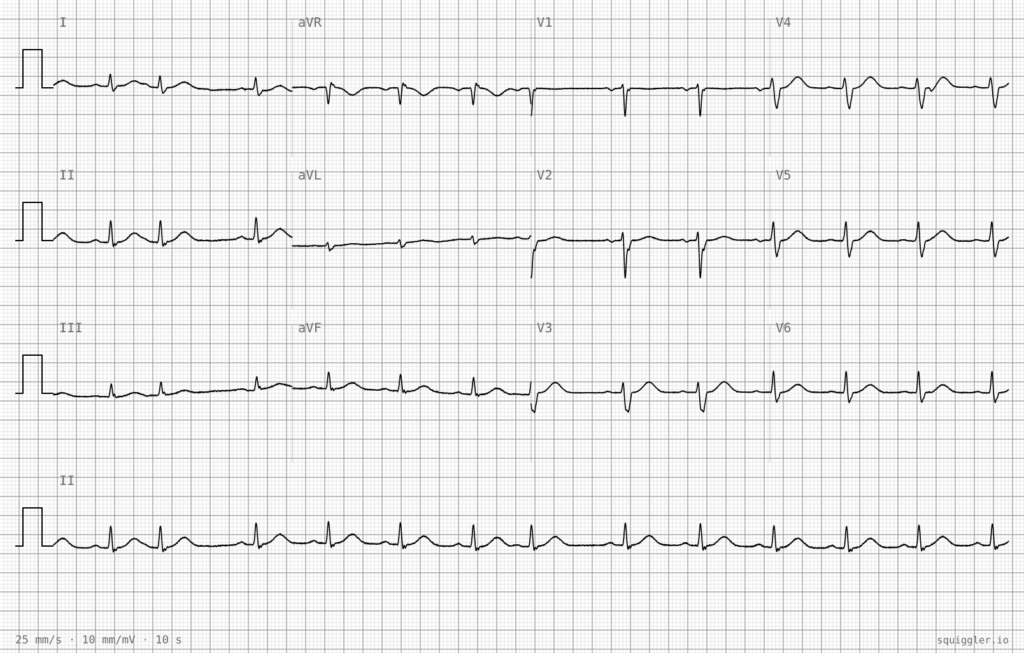 ECG Case 138 Three months of palpitations 02